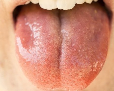 Развалени зъби, подути венци и рак на устната кухина – всеки втори в света се бори с орални болести