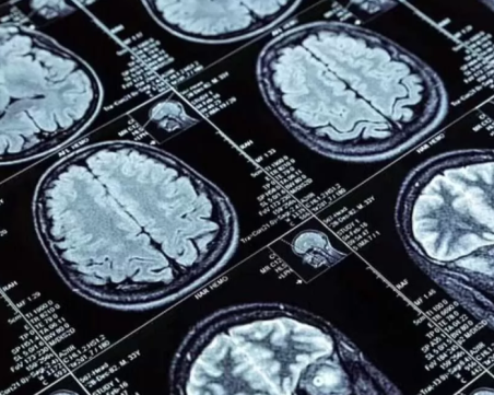 Мистерия: 24-годишен онкоболен шотландец забрави родния си език и проговори на френски