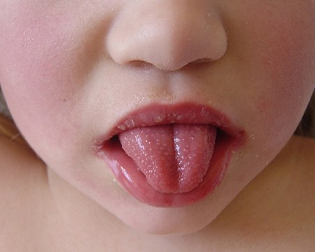 Пик на скарлатионата у нас! Има нови 121 случая само за седмица