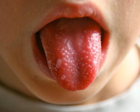 От началото на годината: 23 нови случая на скарлатина в Пловдив