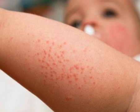 1000 нови случая на варицела у нас само за седмица