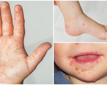 Коксаки вирус плъзна в пловдивските детски градини посред зима