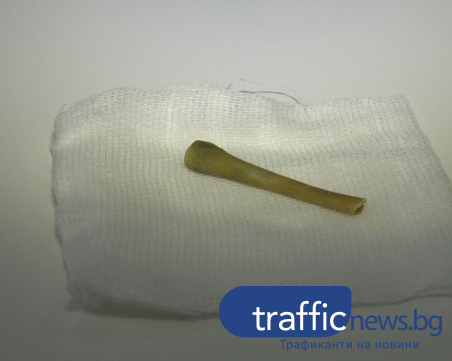 Лекари от Пловдив извадиха кост от пиле, заседнала преди 4 месеца в бронхи на пациент ВИДЕО