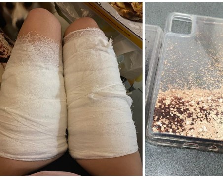 Калъф за телефон изгори краката на пловдивчанка! Тя стигна до болница