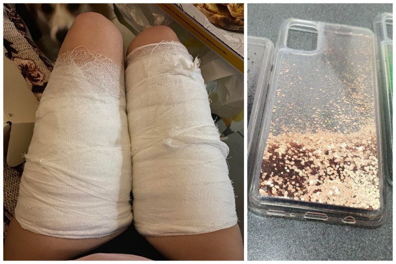 Калъф за телефон изгори краката на пловдивчанка! Тя стигна до болница