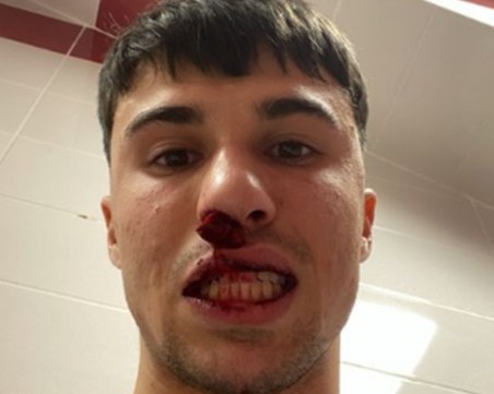 Фен на Сиваспор влезе на терена и счупи носа на играч на Фиорентина