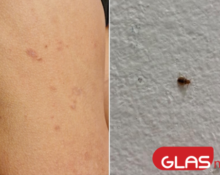 Родител: Столично училище е пълно с дървеници, много от децата са нахапни