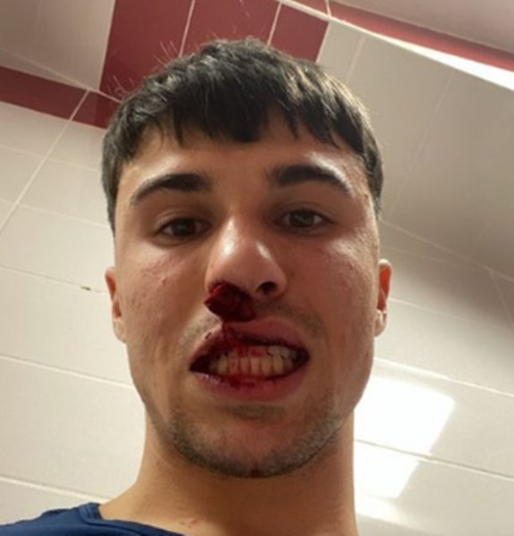 Фен на Сиваспор влезе на терена и счупи носа на играч на Фиорентина