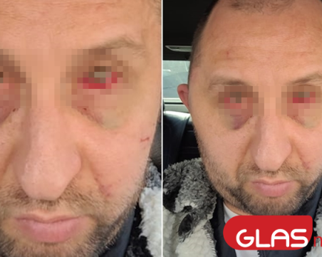 Полицейско насилие във Варна? Мъж твърди, че униформени са му бъркали в очите