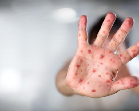 Ваксината срещу варицела може да стане задължителна