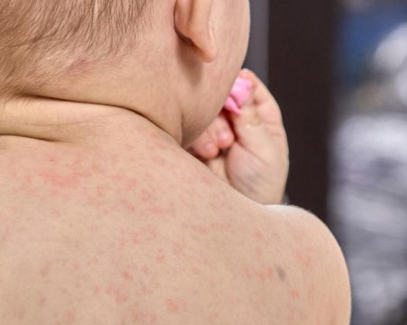 Проф. Христова: Случаите на скарлатина у нас намаляват