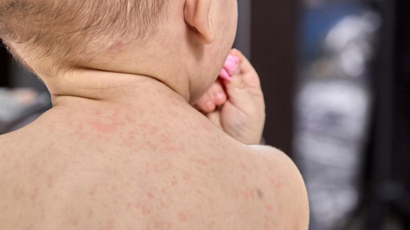 Проф. Христова: Случаите на скарлатина у нас намаляват