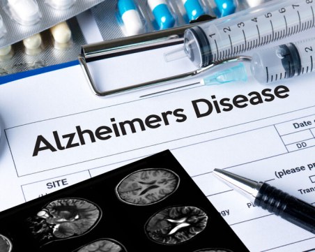 САЩ одобриха първото ефективно лекарство срещу Алцхаймер