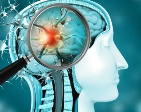 Честата употреба на лекарства за киселини може да доведе до деменция