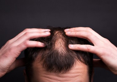 Загубата на коса под една или друга форма  поради естествени причини