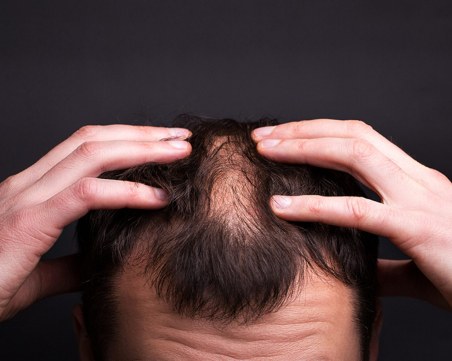 Как 3D принтирането може да помогне при загубата на коса?