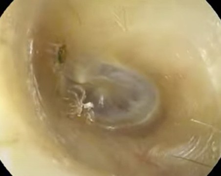 Извадиха паяк от ухото на жена в Тайланд