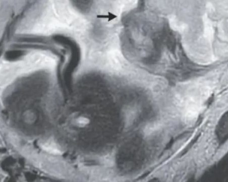 Лекар към жена с болки в корема: Имате бебе в червото