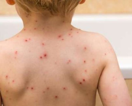 Епидемия от морбили и коклюш избухва и в Босна