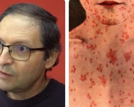 Д-р Сотиров: Морбили може да доведе до сериозна пандемия, по-страшна от тази през 2010 г.