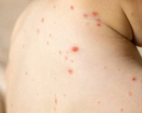 Първи случай на морбили при 15-годишно дете в Сърбия