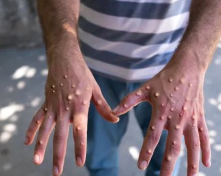 Първа жертва на вируса на Alaskapox