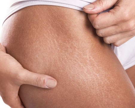 Как може да се предотврати появата на стрии?