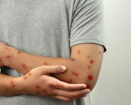 СЗО предупреди за рязък ръст на случаите на морбили по света