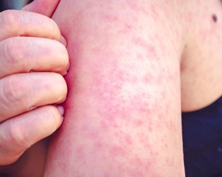 Няма случаи на морбили у нас от началото на годината