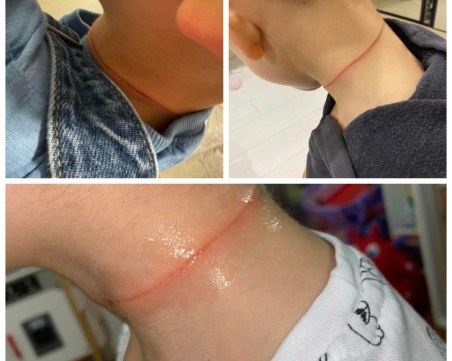 Скъсана катерушка едва не преряза врата на дете в Стара Загора