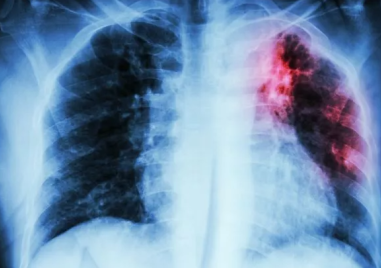 Учени от Холандия предупреждават за нов щам на туберкулоза който