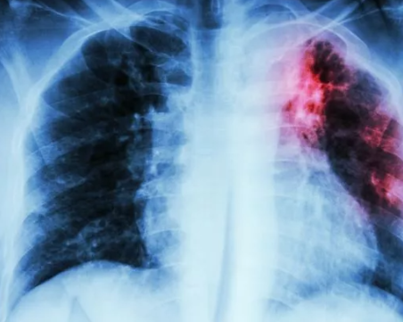 Нов смъртоносен и безсимптомен щам на туберкулоза се разпространява