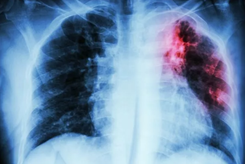 Нов смъртоносен и безсимптомен щам на туберкулоза се разпространява