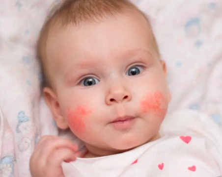 „Училище за родители и деца с атопичен дерматит” идва в Пловдив