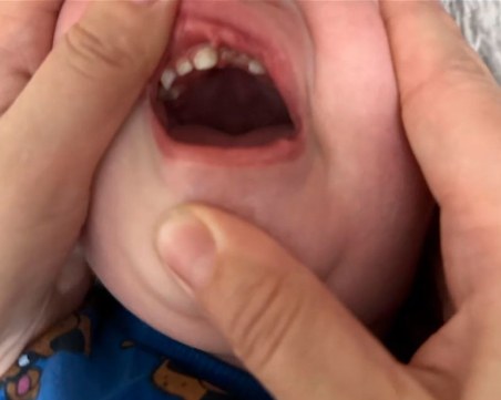 След детски център в Пловдив: Дете е с разбита уста, счупен зъб и синини