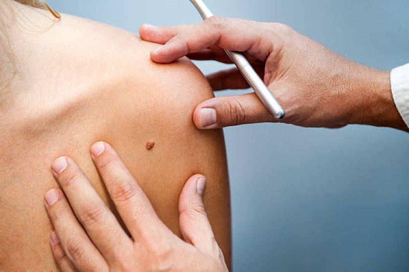 Тестват първата персонализирана инжекция срещу рак на кожата