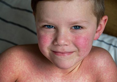 Вирусна инфекция наричана петата болест се разпространява все повече в