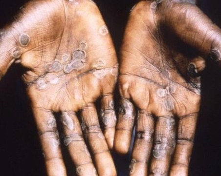 Обявиха извънредно положение в Африка заради бума на маймунска шарка