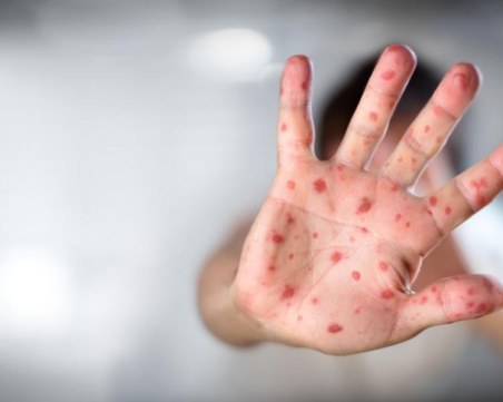 СЗО: Маймунската шарка не е COVID-19, може да се контролира