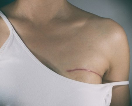 Онколог: Ракът засяга все повече млади хора, една от причините - ултрапреработените храни