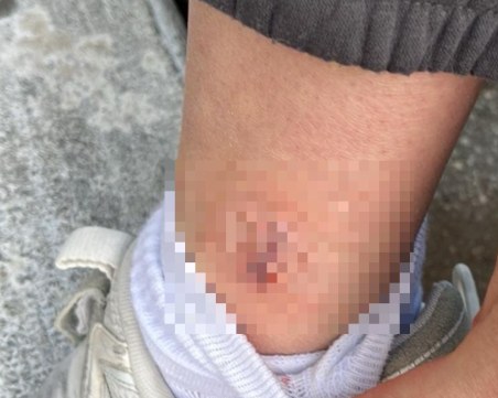 Жена твърди, че е ухапана от бездомно куче в Първомай, кметът: Не сме получили сигнал