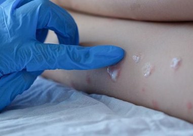 Първият за годината случай на маймунска вариола monkey pox е