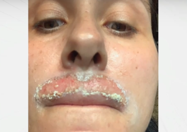 Жена твърди че е обезобразена след дерматологична процедура с лазер