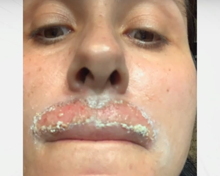 Жена твърди, че е обезобразена след дерматологична процедура с лазер