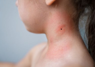 Ако си заразен с лаймска болест след ухапване от кърлеж