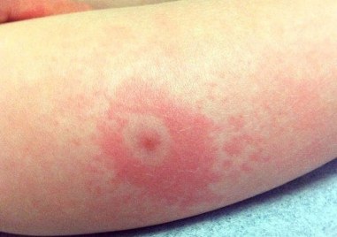 Сега е сезонът на кърлежите чиято активност ще се засилва със