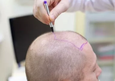 38 годишен британец почина при присаждане на коса в Турция съобщава