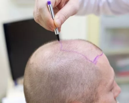 Мъж почина при присаждане на коса в Турция