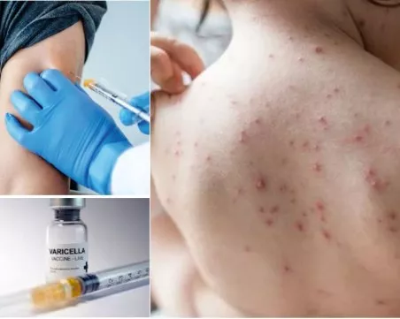 Пловдивчани масово търсят ваксина срещу варицела, родители имунизират децата преди 15 септември