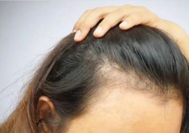 Експериментален серум може да възстанови косата след оплешивяване